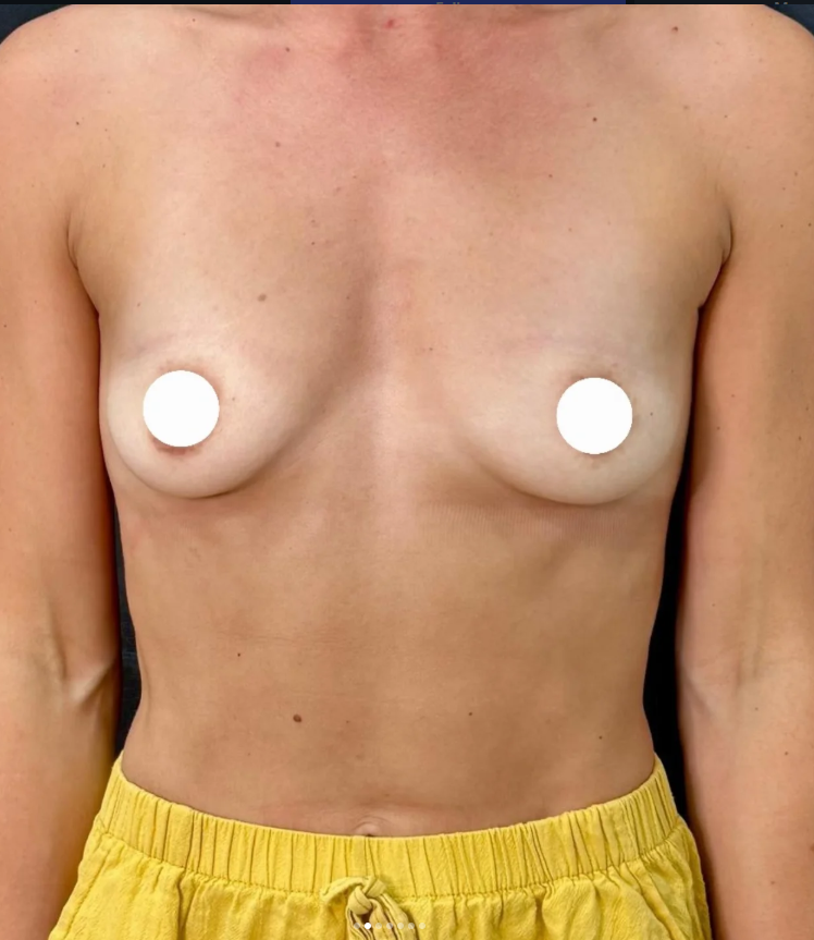 Breast Augmentation Before